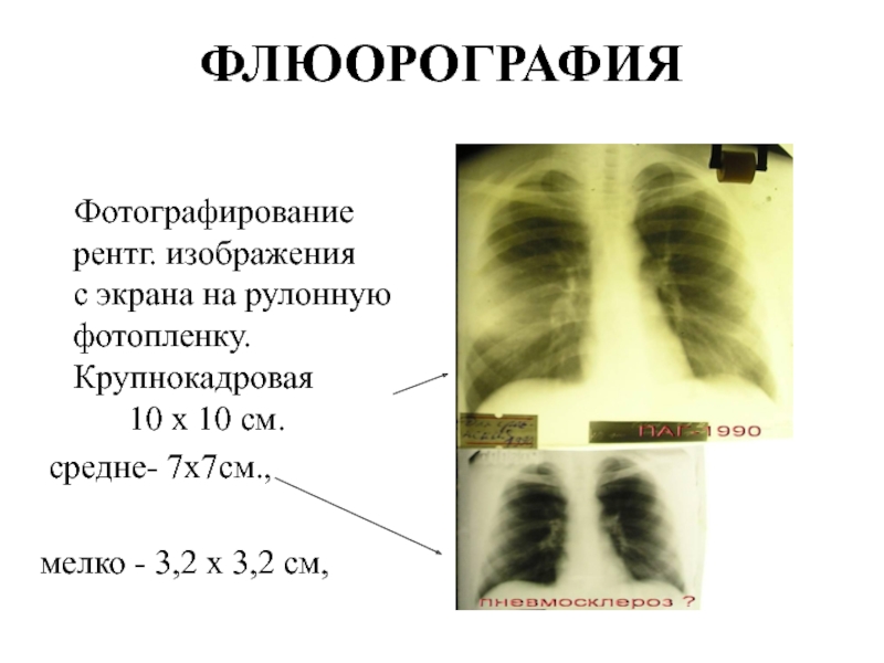 Перед флюорографией