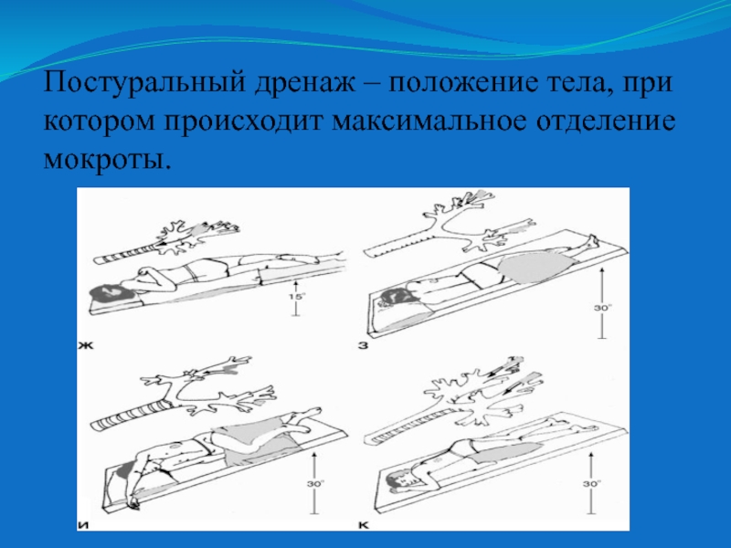 Дренажное положение. Позиционный (Постуральный) дренаж. Постуральный дренаж Фаулера. Постуральный дренаж схемы. Положение постурального дренажа.