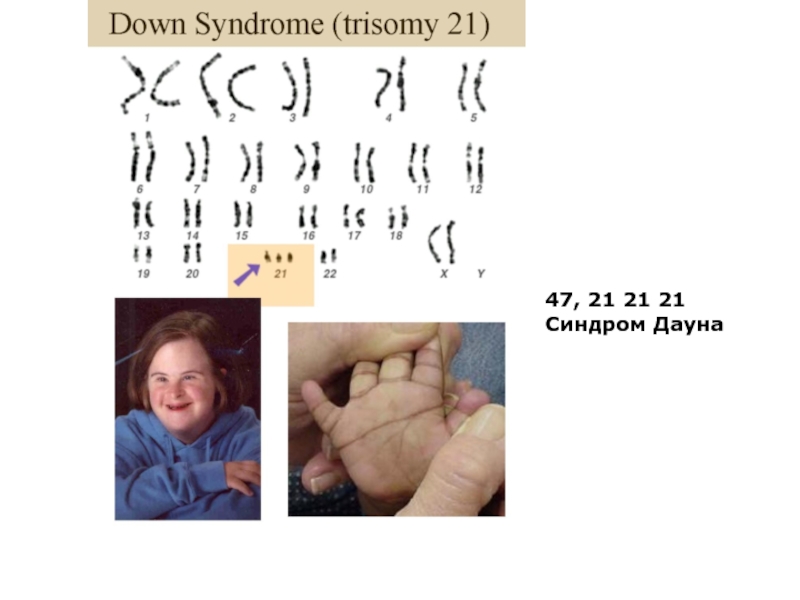 Синдром дауна презентация по генетике