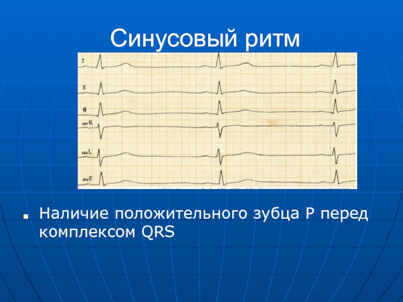 Р перед. Критерием синусового ритма является наличие. Наличие положительного зубца p. Р перед QRS. Двойные р перед комплексом QRS.