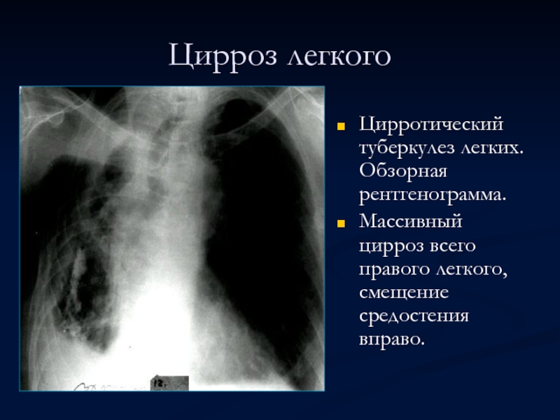 Цирроз легкого  Цирротический туберкулез легких. Обзорная рентгенограмма. Массивный цирроз всего правого легкого, смещение средостения вправо.