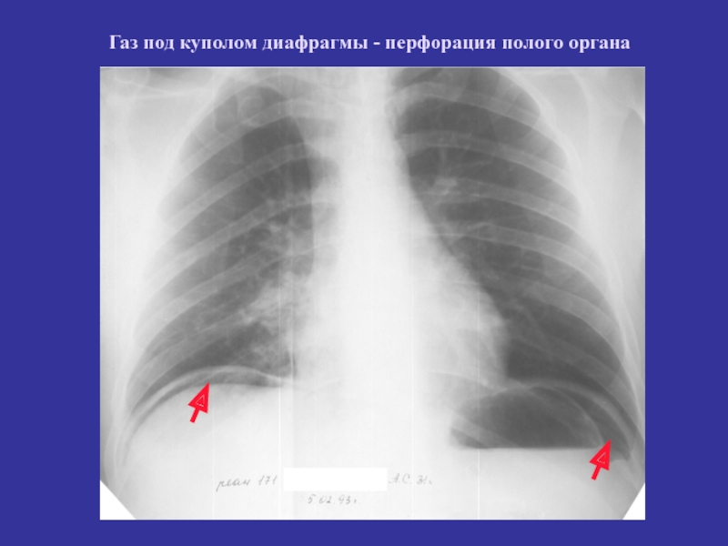 Свободный газ. Свободный ГАЗ под куполом диафрагмы рентген. Свободный ГАЗ под диафрагмой рентген. Свободный ГАЗ В брюшной полости рентген. Перфорация язвы рентген.