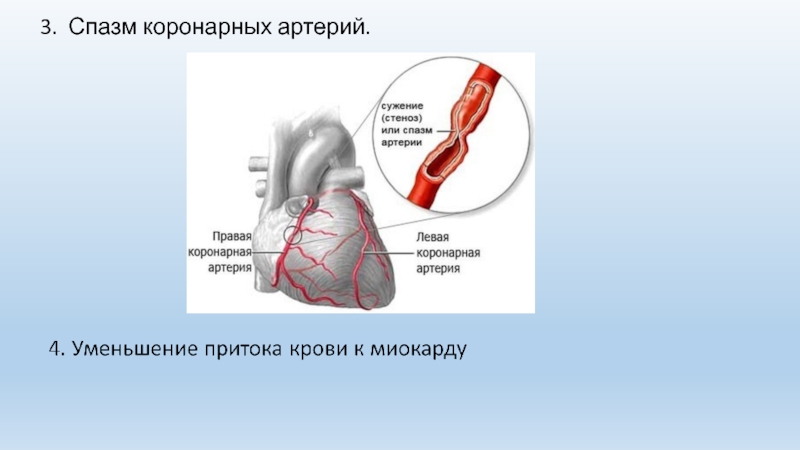 Вазоспазм это