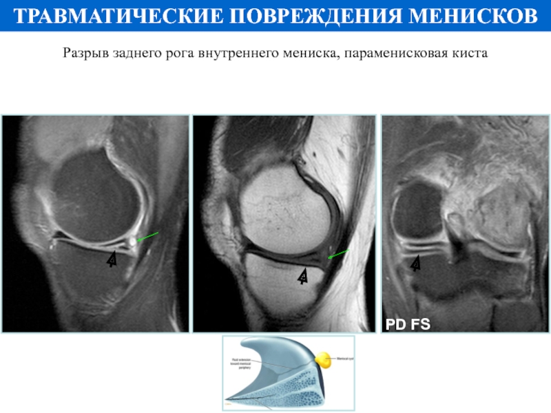 Разрыв мениска фото узи