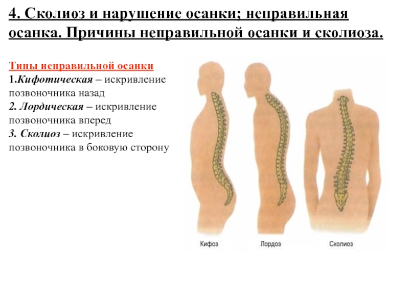 Сколиоз проект по биологии