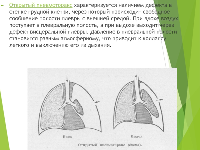 Закрытый пневмоторакс карта вызова