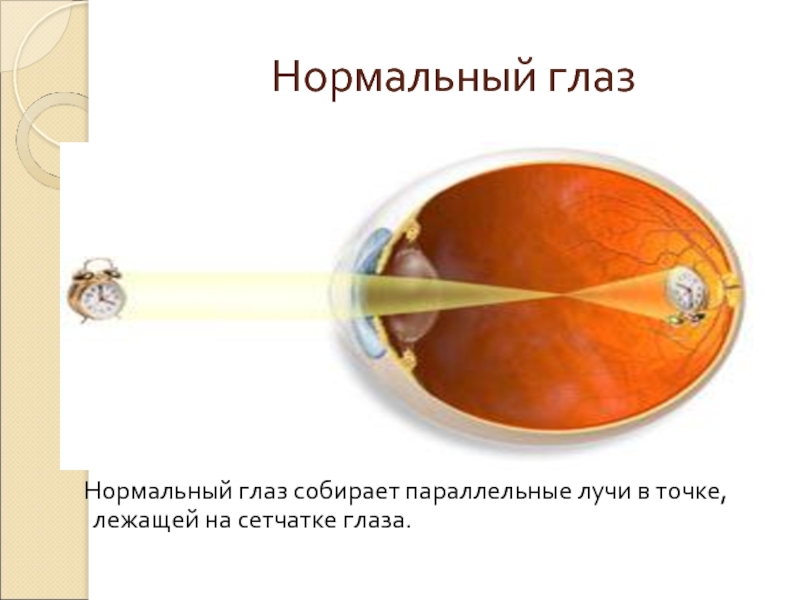 Нормальный глаз  Нормальный глаз собирает параллельные лучи в точке, лежащей на сетчатке глаза.