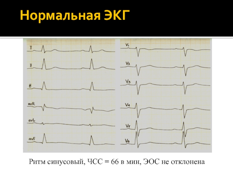 Отклонения на экг