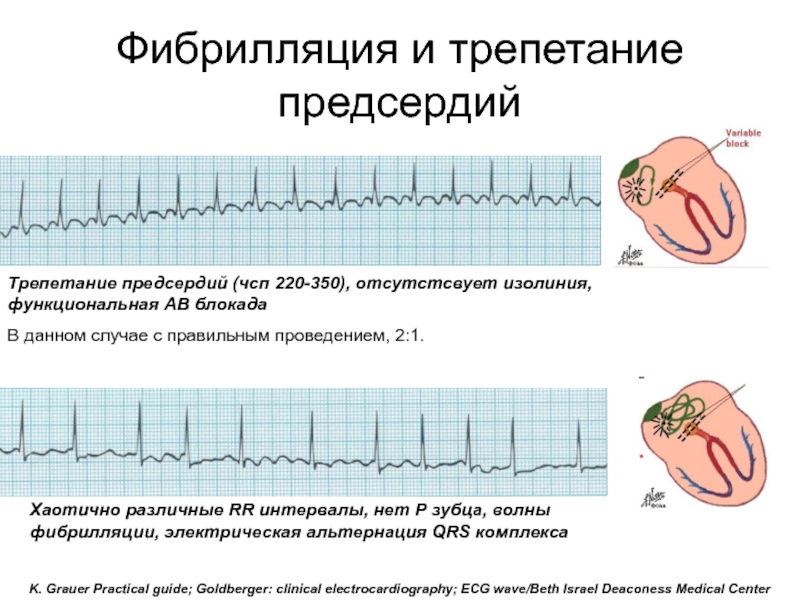 Трепетание предсердий карта вызова скорой медицинской помощи