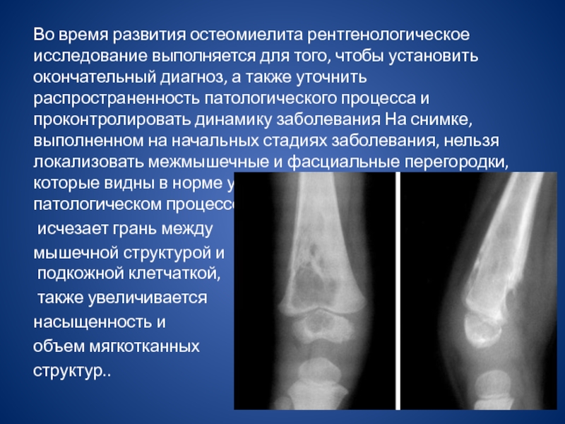 Рентгенодиагностика остеомиелита презентация