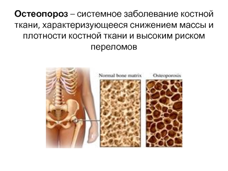 Остеопороз – системное заболевание костной ткани, характеризующееся снижением массы и плотности костной ткани и высоким риском переломов