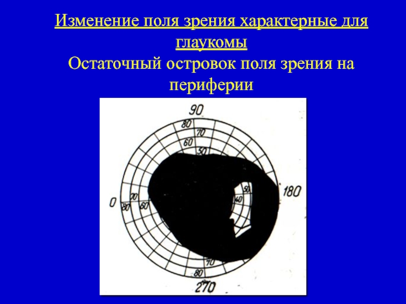 Как изменяется поле зрения. Периметрия при глаукоме по стадиям. Изменение полей зрения. Изменение полей зрения при глаукоме. Поле зрения характеризует.