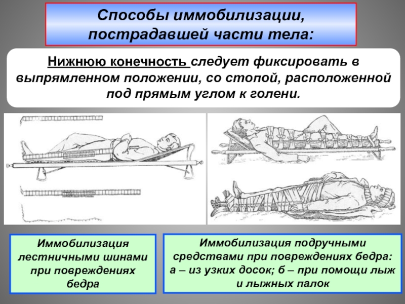 Правила транспортной иммобилизации конечностей. Иммобилизация конечности к другой конечности. Ошибка при иммобилизации всей нижней конечности лестничными шинами.