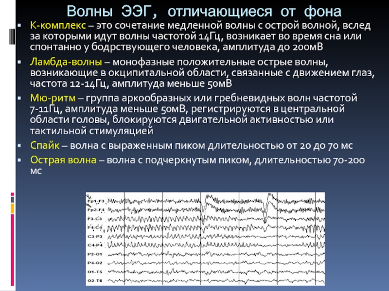 Медленный комплекс пик медленная волна. Комплекс острая медленная волна на ЭЭГ. Острая волна медленная волна на ЭЭГ. Пик волна на ЭЭГ. Медленные волны на ЭЭГ.