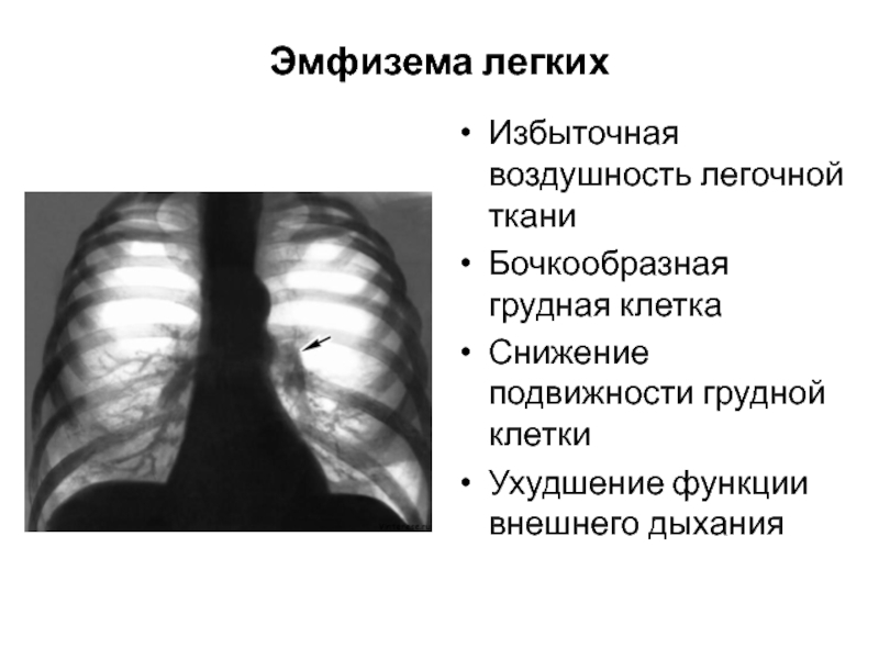 Эмфизема легкихИзбыточная воздушность легочной тканиБочкообразная грудная клеткаСнижение подвижности грудной клеткиУхудшение функции внешнего дыхания