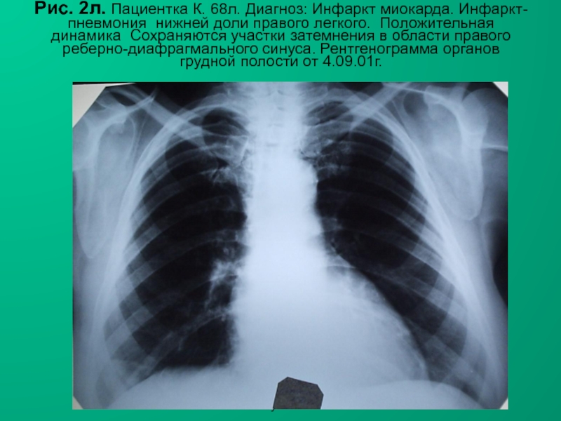 Н.С. Воротынцева, С.С. Гольев РентгенопульмонологияРис. 2л. Пациентка К. 68л. Диагноз: Инфаркт миокарда. Инфаркт-пневмония нижней доли правого легкого.