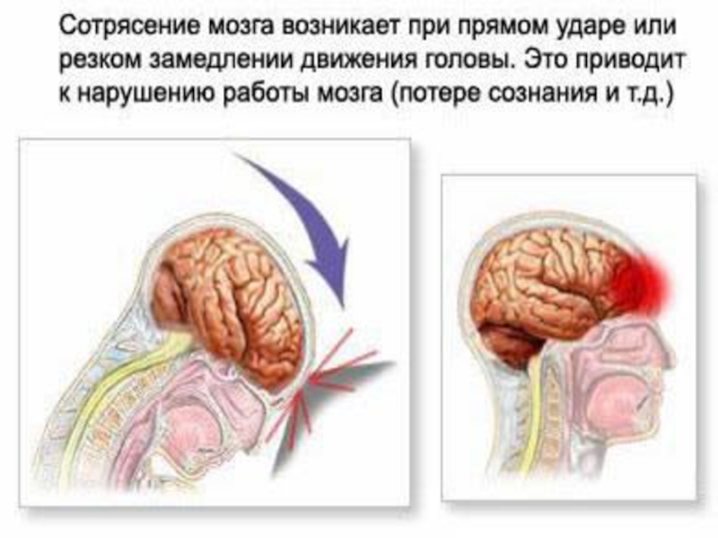 Реферат: Травма позвоночника, спинного и головного мозга