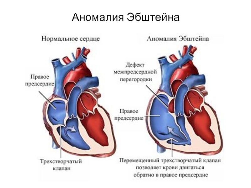 Аномалия эбштейна фото