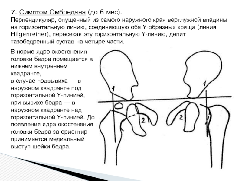 Рентгенологическая картина центрации головки бедра в пределах вертлужной впадины с обеих сторон