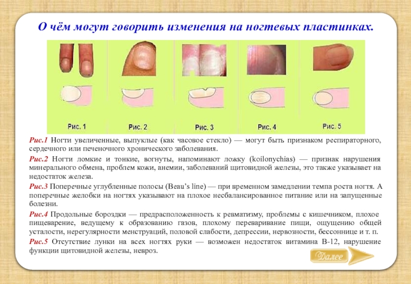 Определение болезни по ногтям. Заболевания ногтевой пластины.
