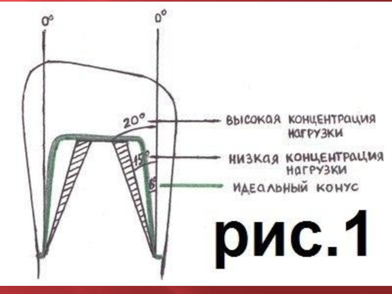 Препарирование под металлическую коронку схема