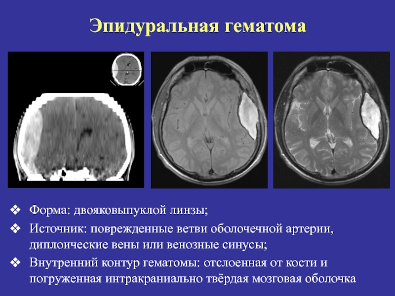 Острая субдуральная гематома клиническая картина