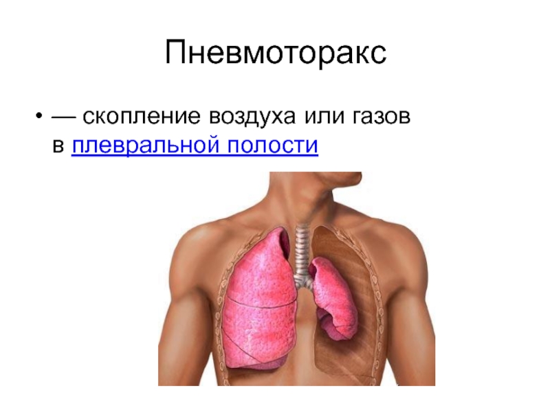 Клапанный пневмоторакс презентация