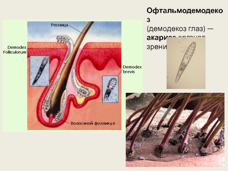 Демодекоз век схема