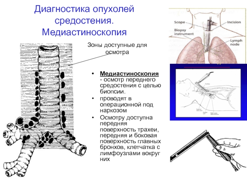 Топографическая анатомия переднего и заднего средостения презентация