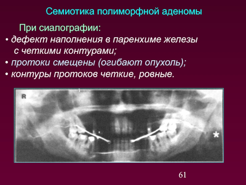 Лучевая терапия при раке слюнных желез