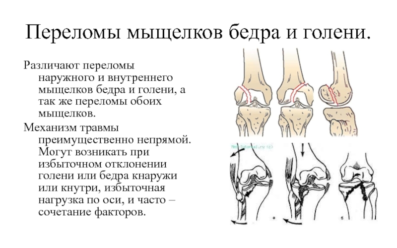 Переломы мыщелков большеберцовой