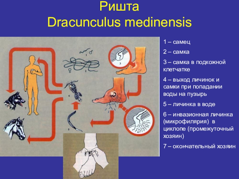 Распространенность гименолепидоза на территории России Ришта Dracunculus medinensis 1 – самец2 – самка3 – самка в Ришта  Dracunculus medinensis 1 – самец2 – самка3 – самка в подкожной клетчатке4 – выход личинок