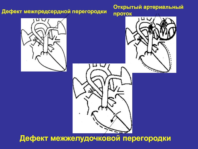 Дефект межпредсердной перегородки у детей презентация