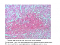 1. Печень при хроническом венозном полнокровии.
Синусоиды в центрах долек