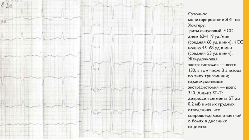 Синусовый ритм холтер. ЭКГ по Холтеру. Суточное ЭКГ по Холтеру. Дневник мониторирования ЭКГ по Холтеру. Ускоренный наджелудочковый ритм Холтер.