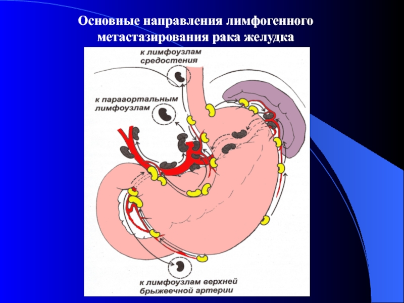 Основные направления лимфогенного  метастазирования рака желудка