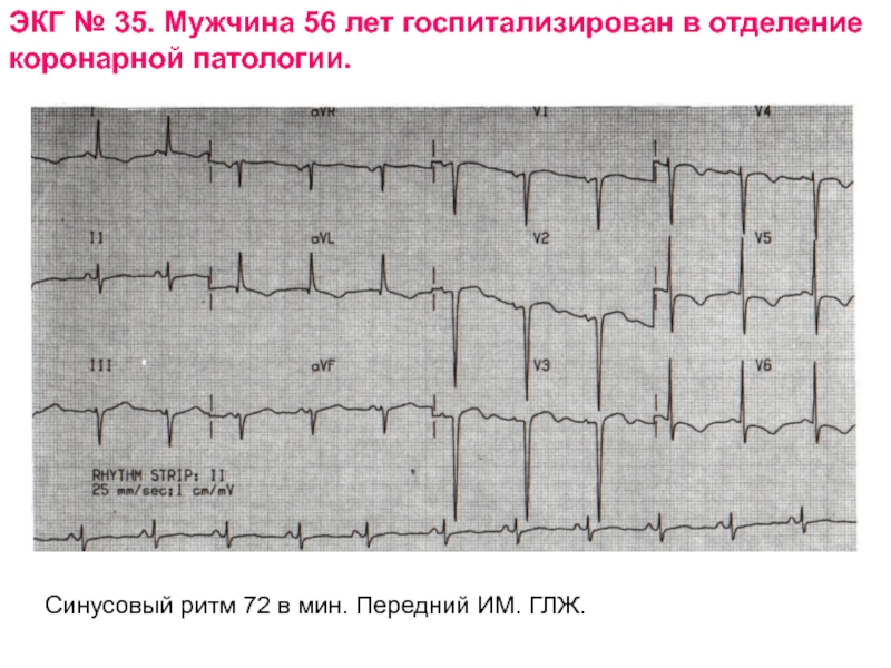 Экг сколько. ЭКГ ритм синусовый блокада 1 гипертрофия левого желудочка. Расшифровка периодов ЭКГ. Примеры ЭКГ С расшифровкой. Патологическая ЭКГ.
