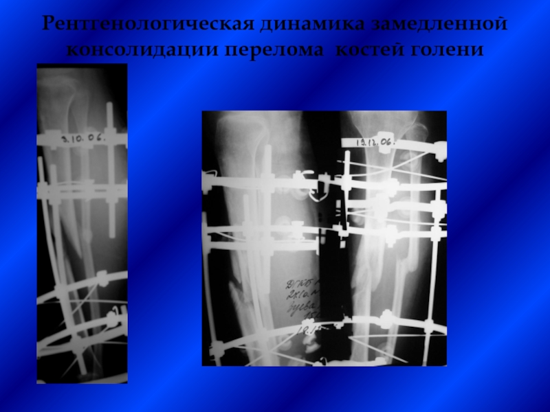 Замедленная консолидация презентация