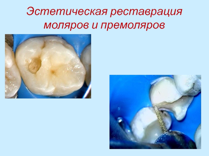 Эстетическая реставрация моляров и премоляров 