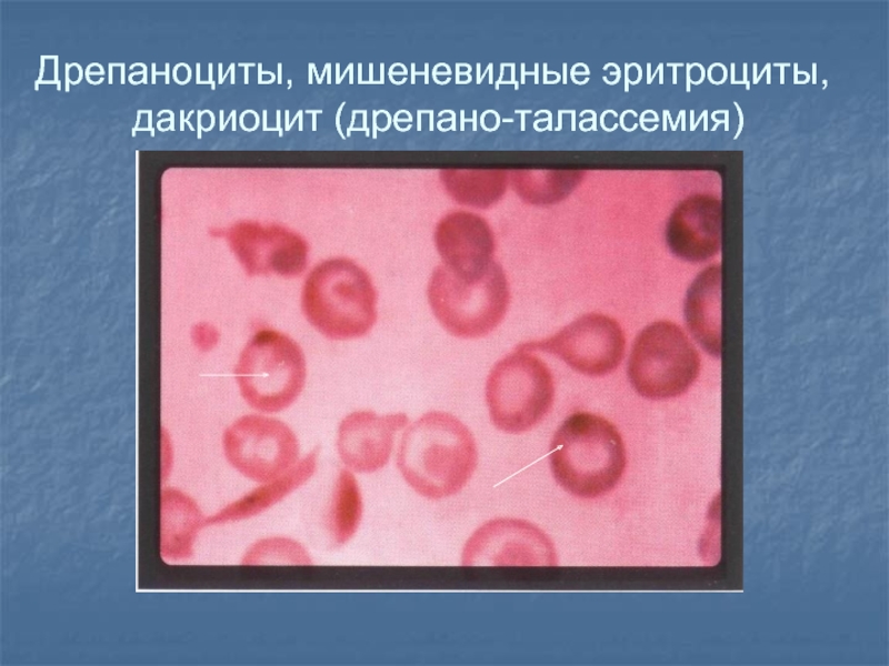 Патология системы крови презентация