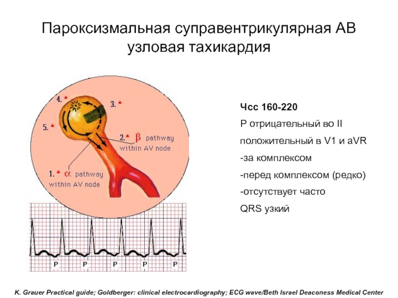 Пароксизмальная тахикардия презентация