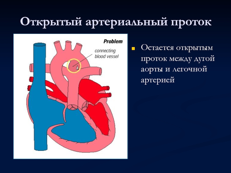 Приобретенные пороки сердца презентации