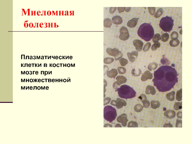 1 плазматическая клетка. Миеломная болезнь плазматические клетки. Плазматические клетки при множественной миеломе. Плазмоциты гистология. Множественная миелома микропрепарат.