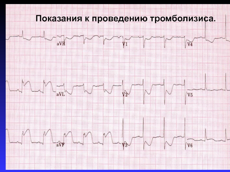 Экг после. Тромболизис ЭКГ. ЭКГ показания к тромболизису. ЭКГ показания. ЭКГ после тромболизиса.