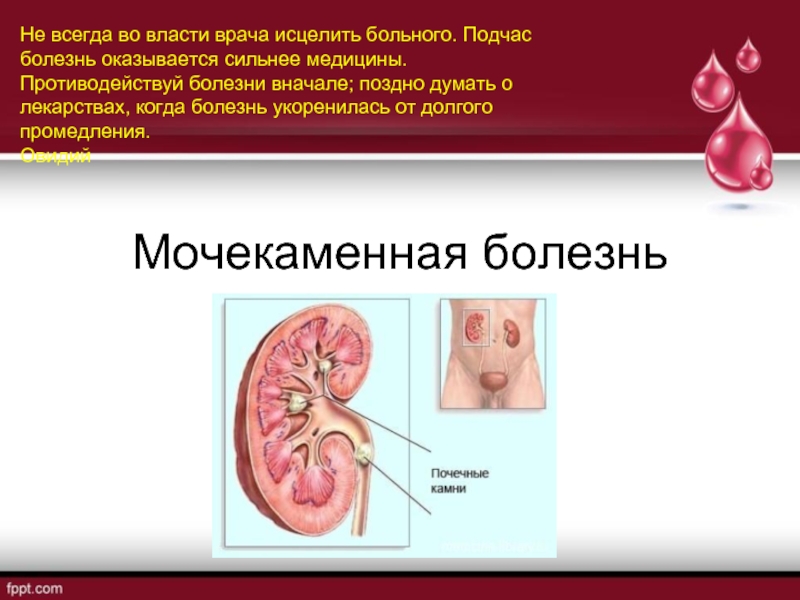 Презентация Мочекаменная болезнь