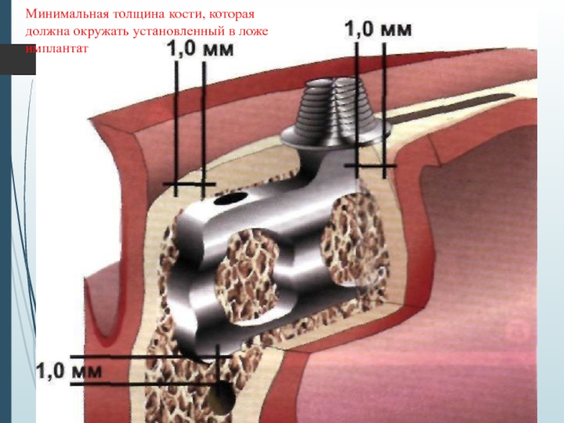 Толщина кости. Толщина кости для импланта. Костное ложе имплантата. Толщина кости при имплантации зубов.