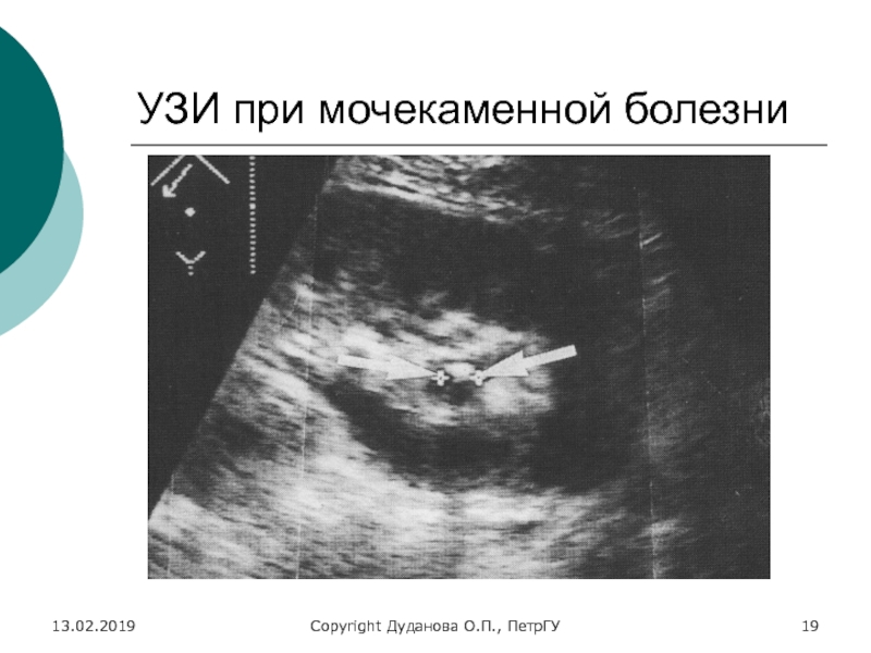 Узи картина мочекаменной болезни