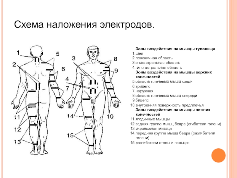 Миостимулятор схема наложения электродов