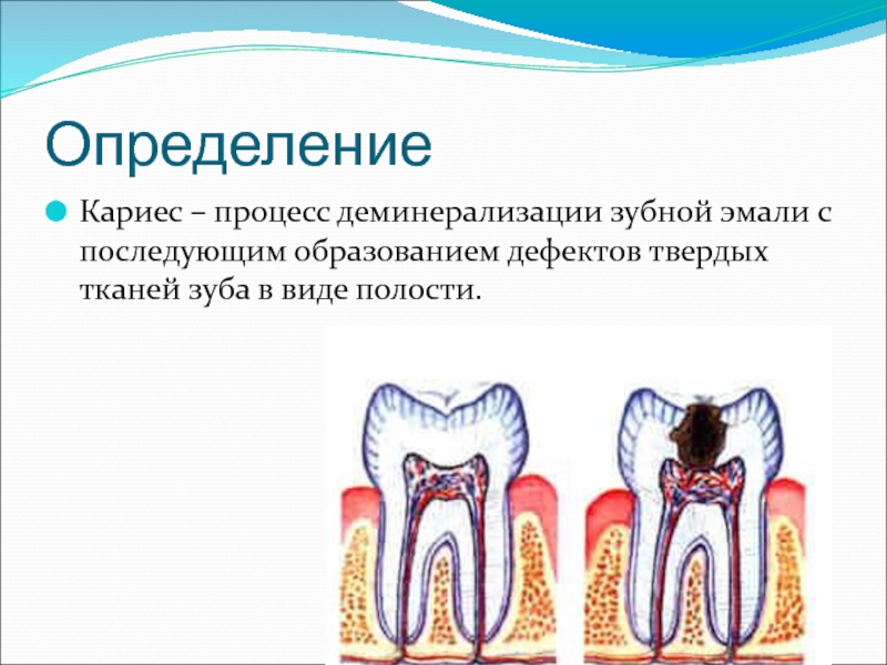 Стадии кариеса картинки