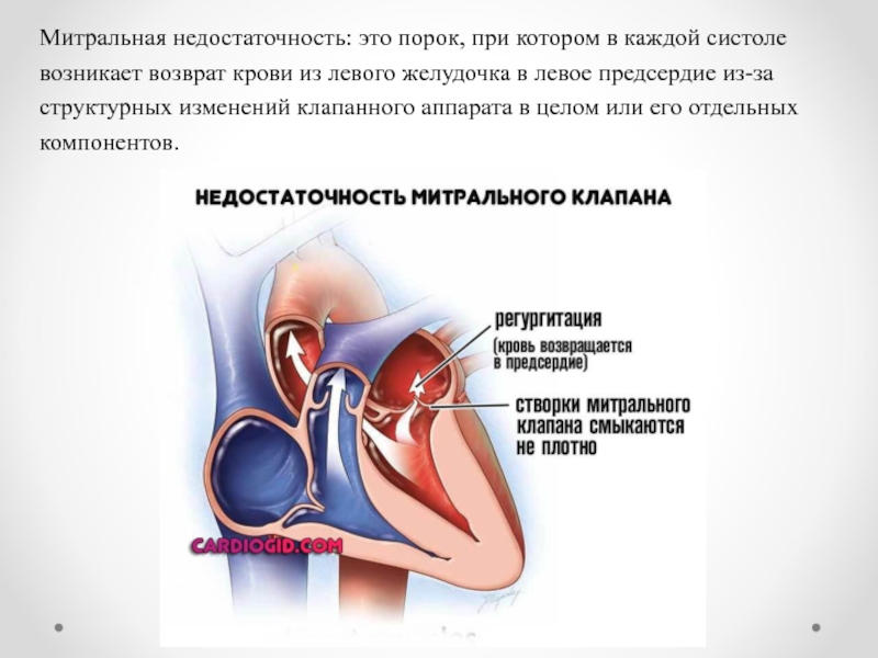 Недостаточность митрального клапана картинка